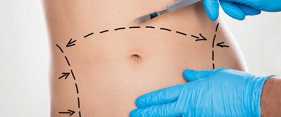 Karın Germe Ameliyatı (Abdominoplasty);
